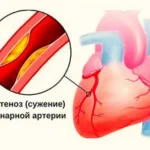 Дифференциальная диагностика стенокардии