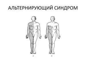 Альтернирующий синдром Авеллиса: характеристика и клинические аспекты