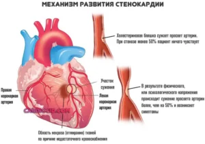 Стенокардия напряжения: патофизиология, клинические проявления и методы лечения