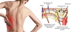 Межреберная невралгия: причины, симптомы и лечение