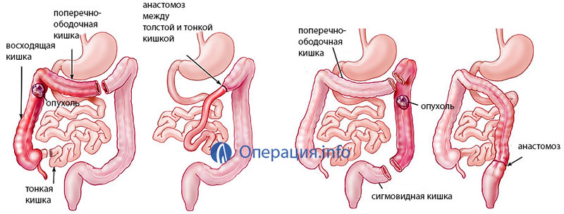 Кишечная непроходимость: Причины, симптомы и лечение