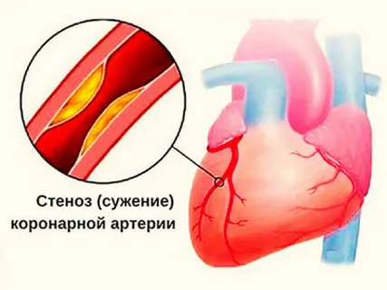 Дифференциальная диагностика стенокардии
